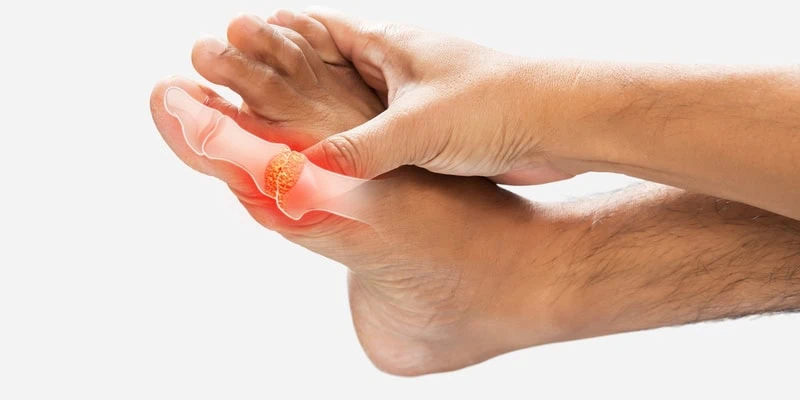 Foot Arthritis