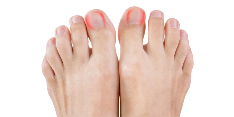 Ingrown Toenails