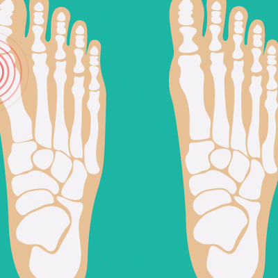 bunion pain treatment Boca Raton Florida