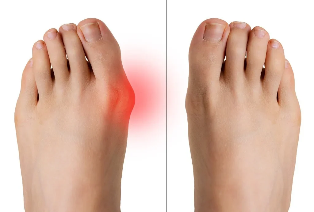 bunion treatment options