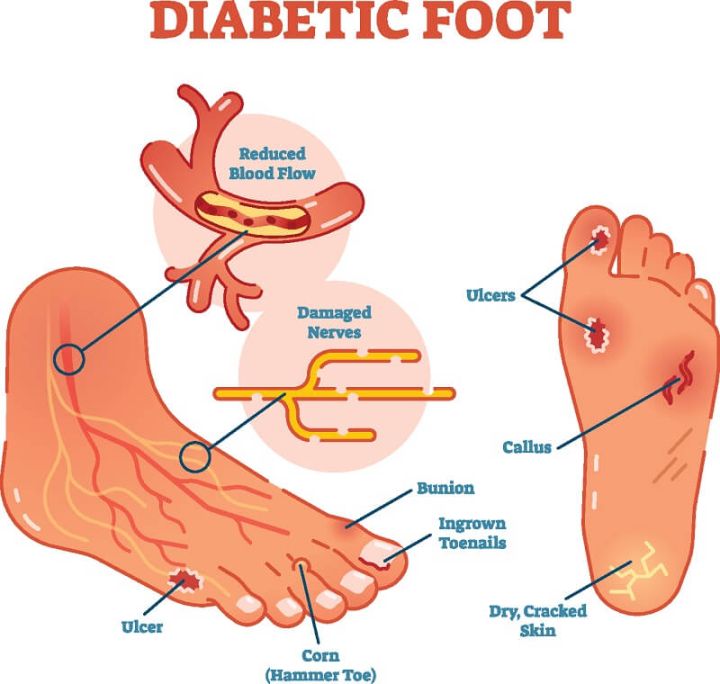 damaged nerve endings in feet