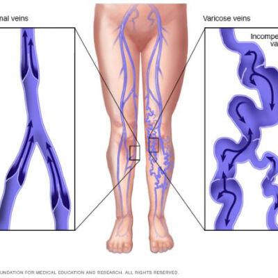 treating varicose veins