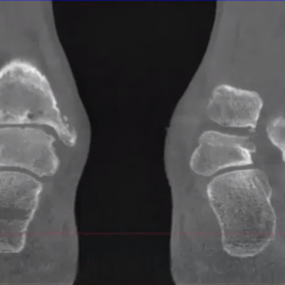 3D pedCAT Scanner for foot and ankle pain | Certified Foot & Ankle Specialists, Boca Raton, Fla.