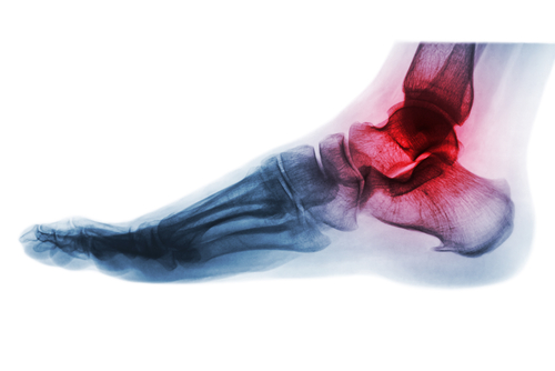 ankle replacement surgery