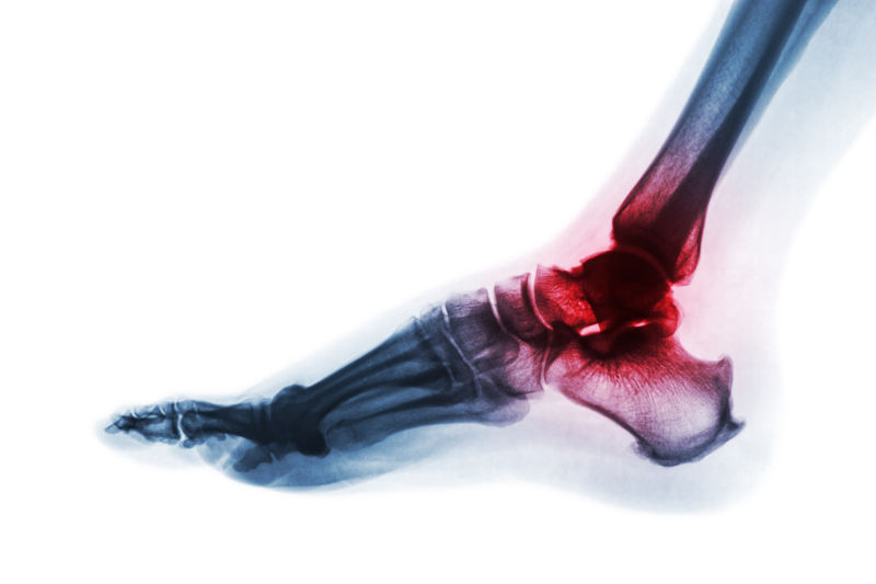 ankle arthritis treatment
