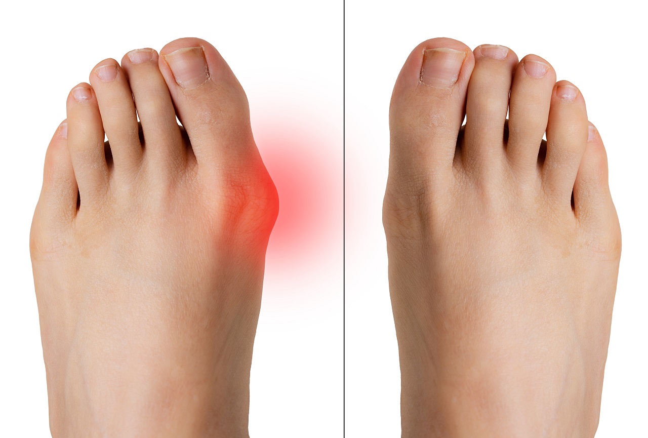 痛风引起关节痛，为何喜欢在大脚趾上发作，原来此处尿酸溶解度低|高尿酸血症|关节痛|溶解度|尿酸钠|-健康界