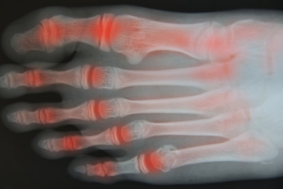 foot arthritis foot arthritis foot and ankle specialists