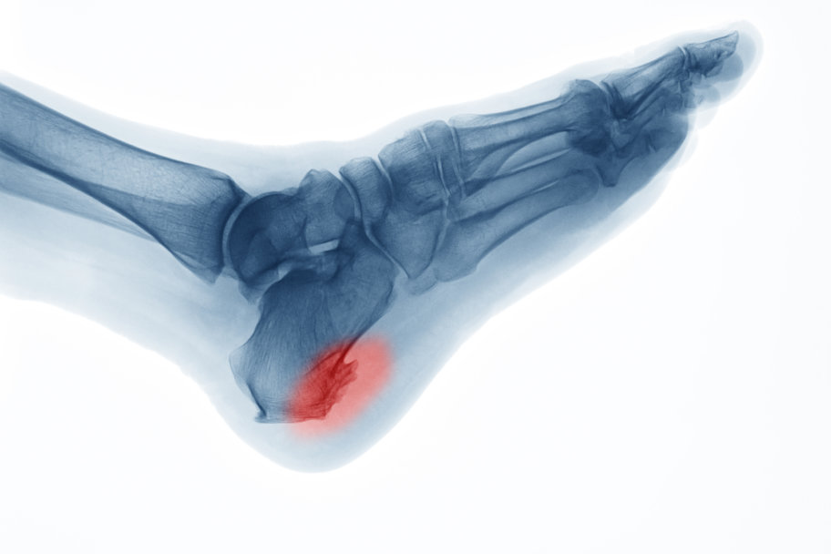 heel spur Heel Spur Syndrome