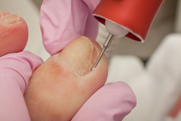 Symptoms and Treatments for Ingrown Toenails