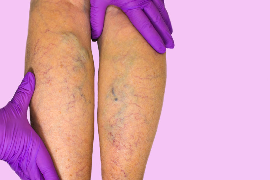 varicose-veins-surgery-varicose-vein-treatment-specialist-boca-raton