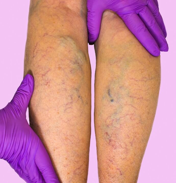 Varicose Veins Treatment and Surgery from Certified Podiatrist