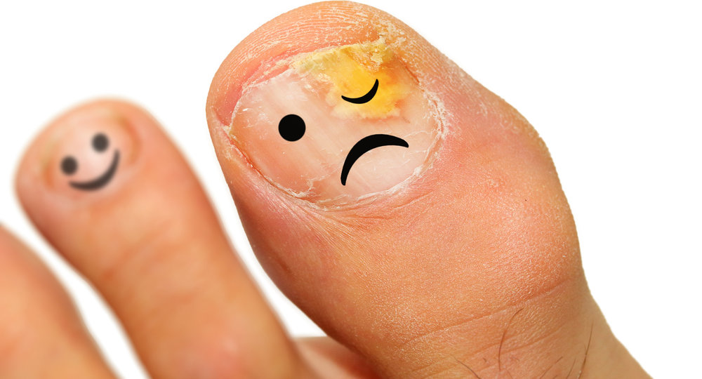 toenail fungus treatment options