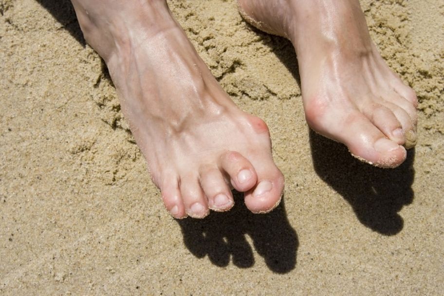hammertoecfas hammertoe treatment certified foot and ankle specialist