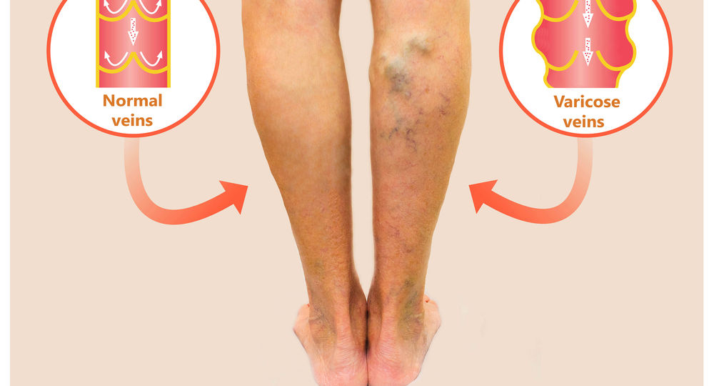 varicose veins