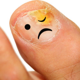 toenail fungus treatment