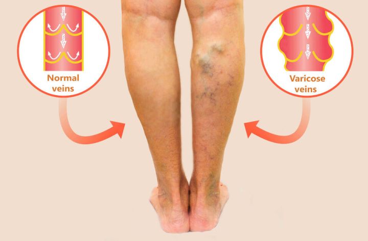 What Age is Normal for Varicose Veins?