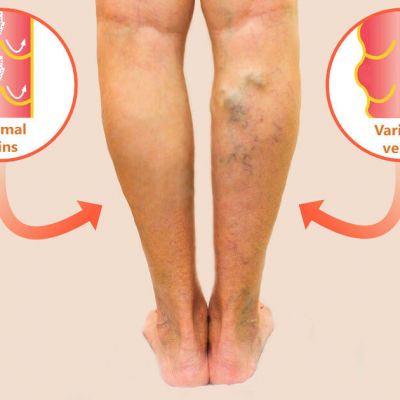 varicose veins treatment boca raton