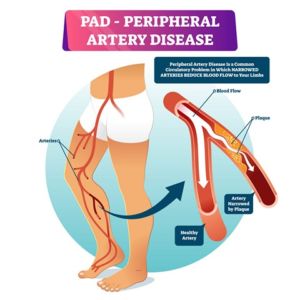 Peripheral Arterial Disease Can Be Treated With Proper Diagnosis