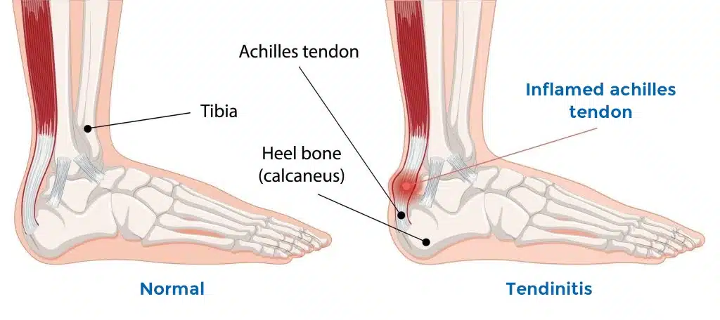 achilles tendonitis infographic