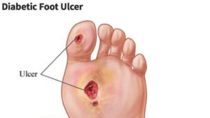 Diabetic Foot Ulcer Diagram