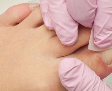 how to treat painful ingrown toenails