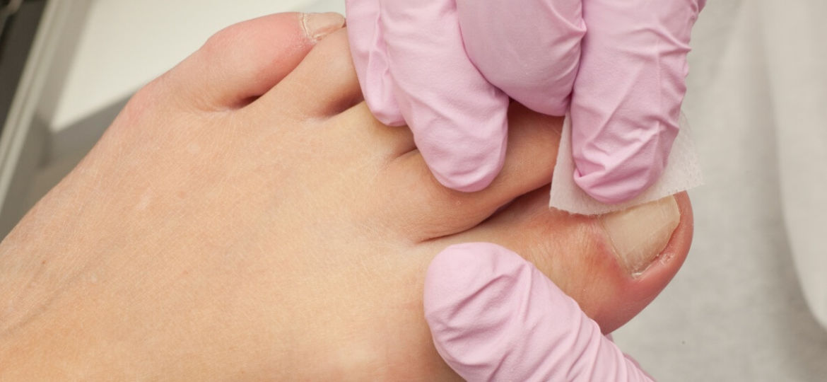 how to treat painful ingrown toenails