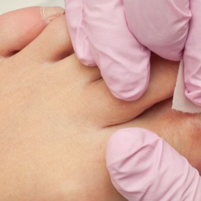 how to treat painful ingrown toenails