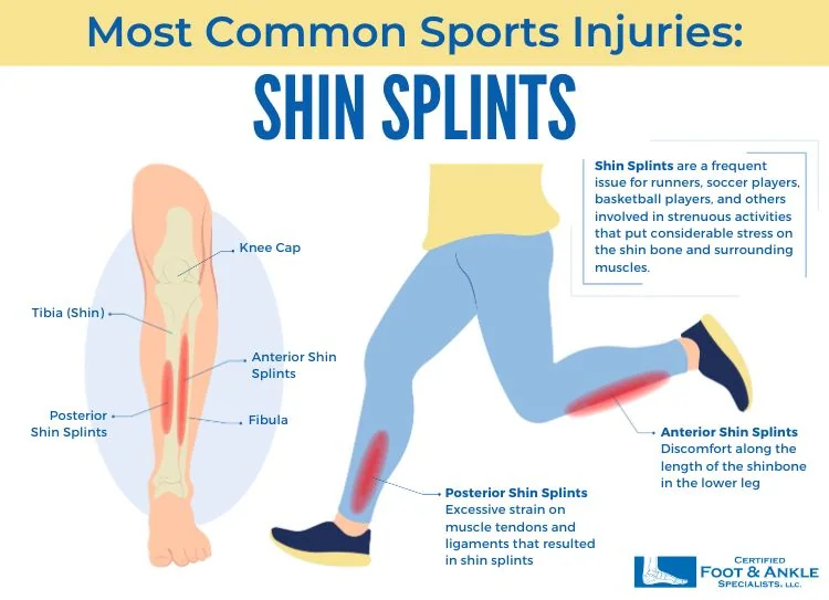 Shin Splints Infographic