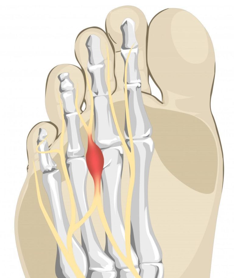 Mortons Neuroma Symptoms Causes And Treatment Options 5409