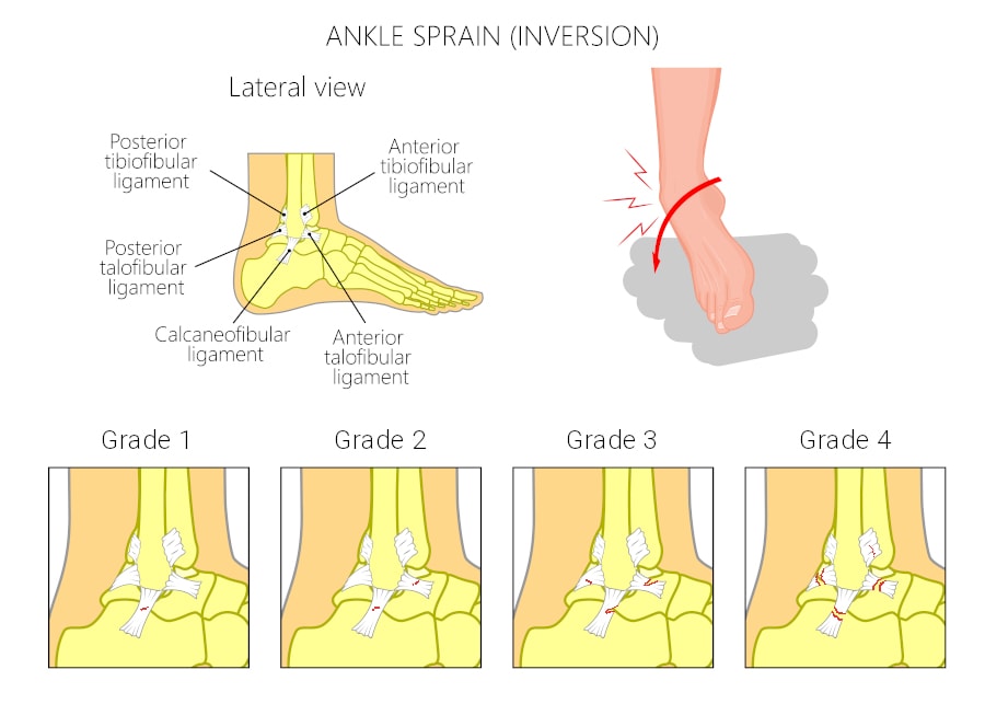 Ankle Sprain Inversion - Different Grades Inforgraphic