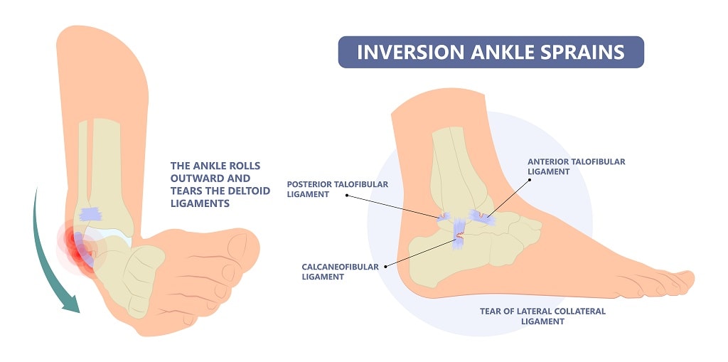 inversion ankle sprain