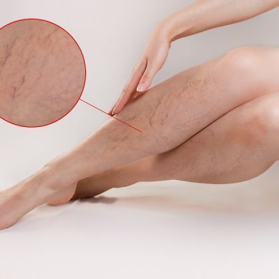 Varicose Veins Hidden Underlying Issues