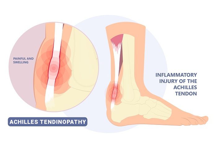 achilles tendinopathy tendinosis