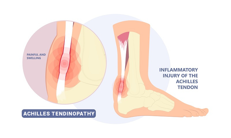 achilles tendinopathy tendinosis