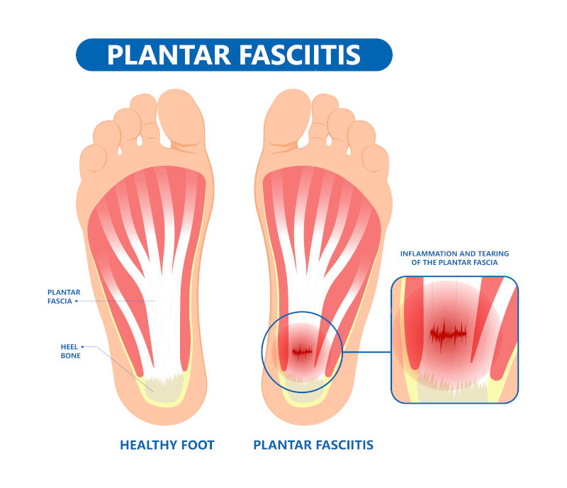 plantar-fasiciitis-tear-infographic