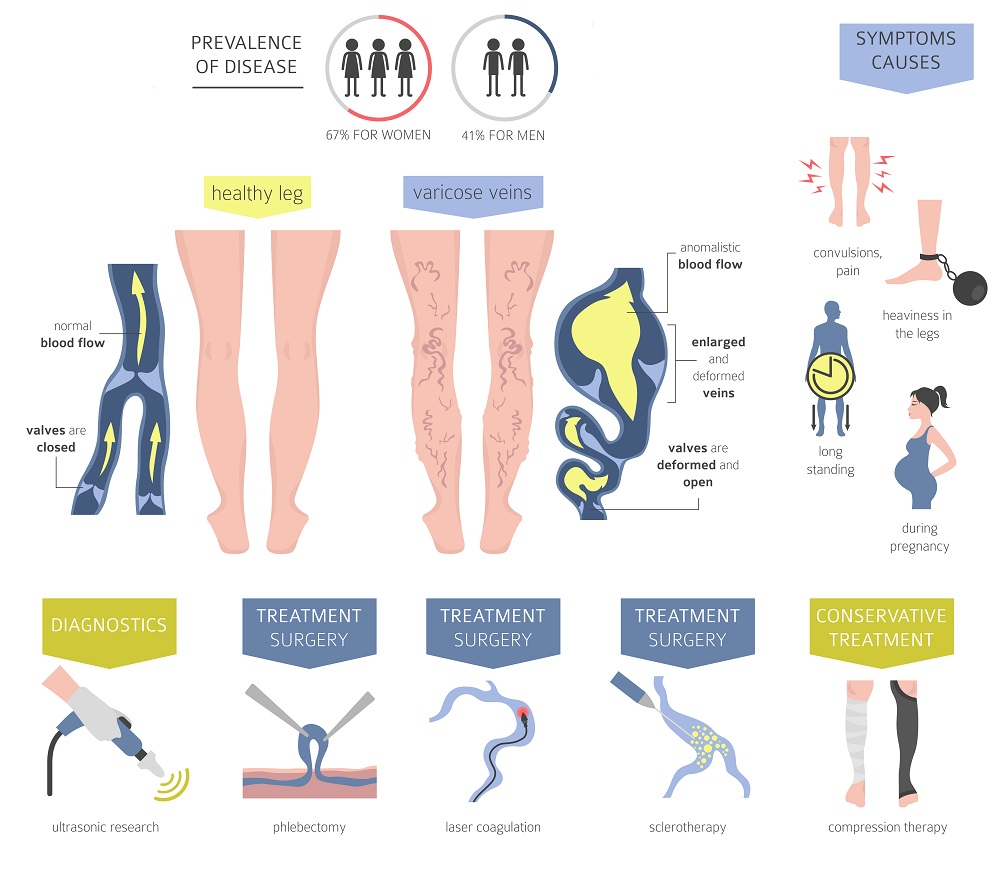 Chronic Venous Insufficiency Causes Symptoms And 41 OFF