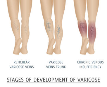 stages-venous-insufficiency