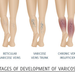 Venous insufficiency is a disease process which can affect all age groups.