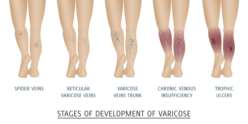 stages-venous-insufficiency