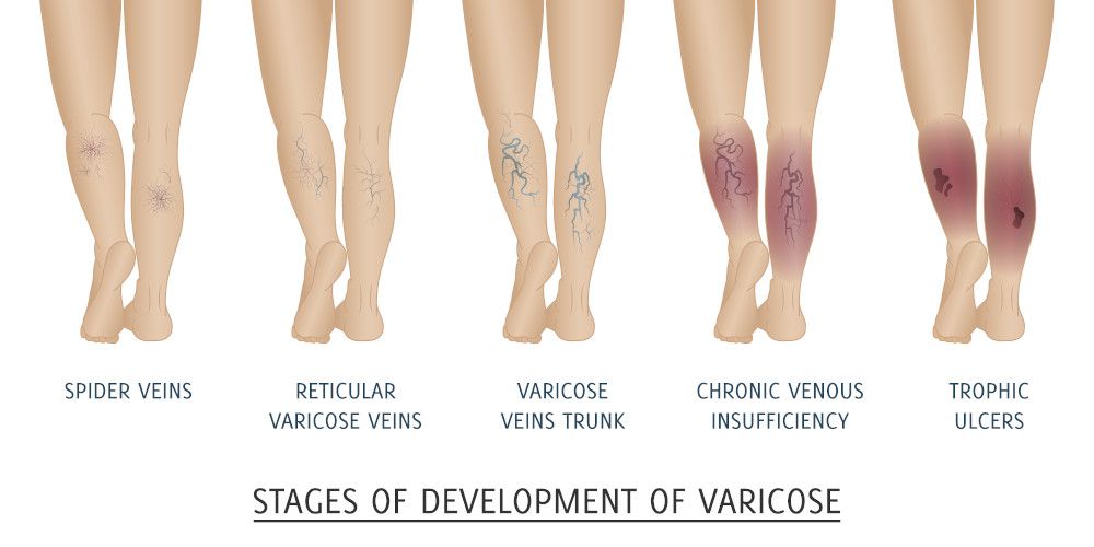 Chronic Venous Insufficiency, Stages of Venous Disease