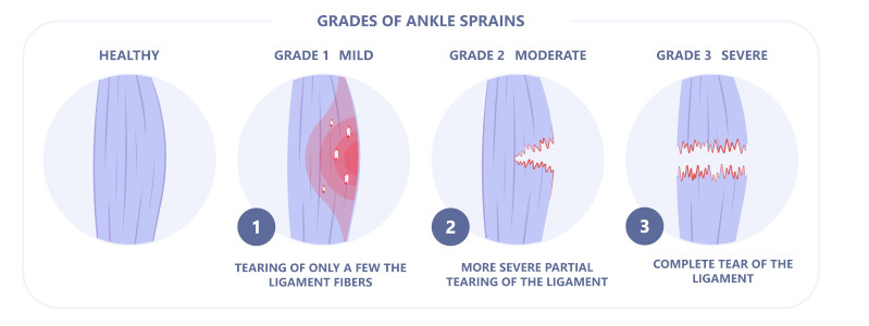 grades-of-ankle-sprains