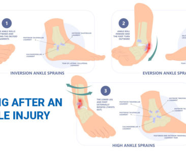 ankle sprain treatment healing-after-ankle-injury