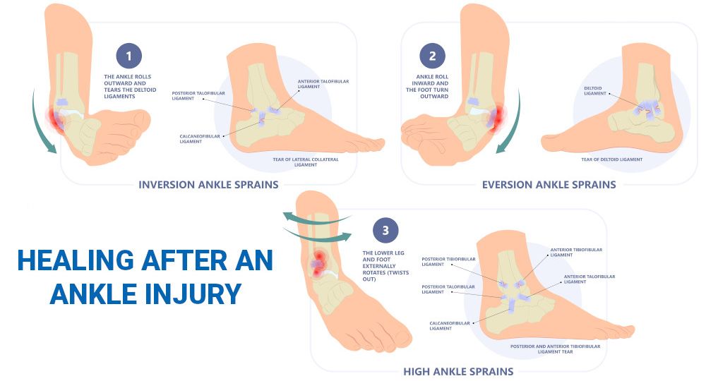 ankle sprain treatment healing-after-ankle-injury