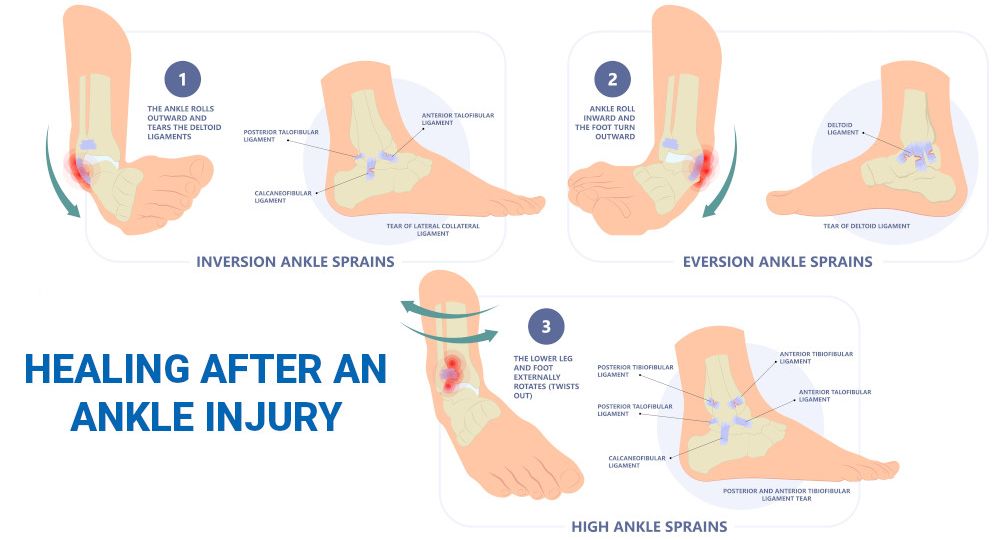 Ankle Sprain Causes, Sprained Ankle