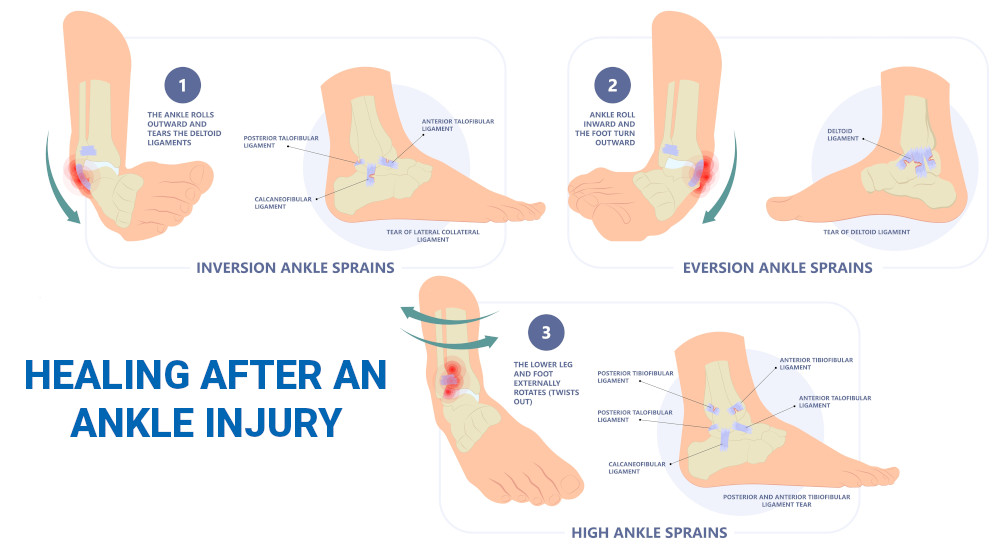 RECOVER FASTER! Ankle Sprain Treatment At Home from a Physical Therapist 