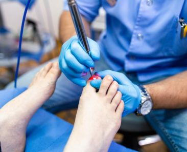 laser treatment toenail fungus treatment
