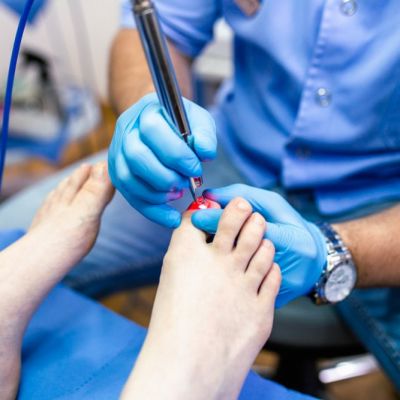 laser treatment toenail fungus treatment