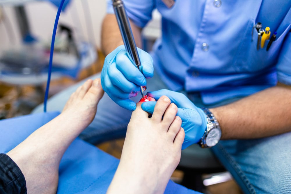 Laser Treatment For Toenail Fungus To Combat Onychomycosis At The Root