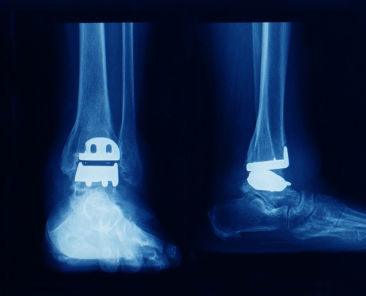 Ankle-Joint-Replacement-Arthroplasty