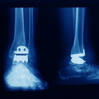 Ankle-Joint-Replacement-Arthroplasty